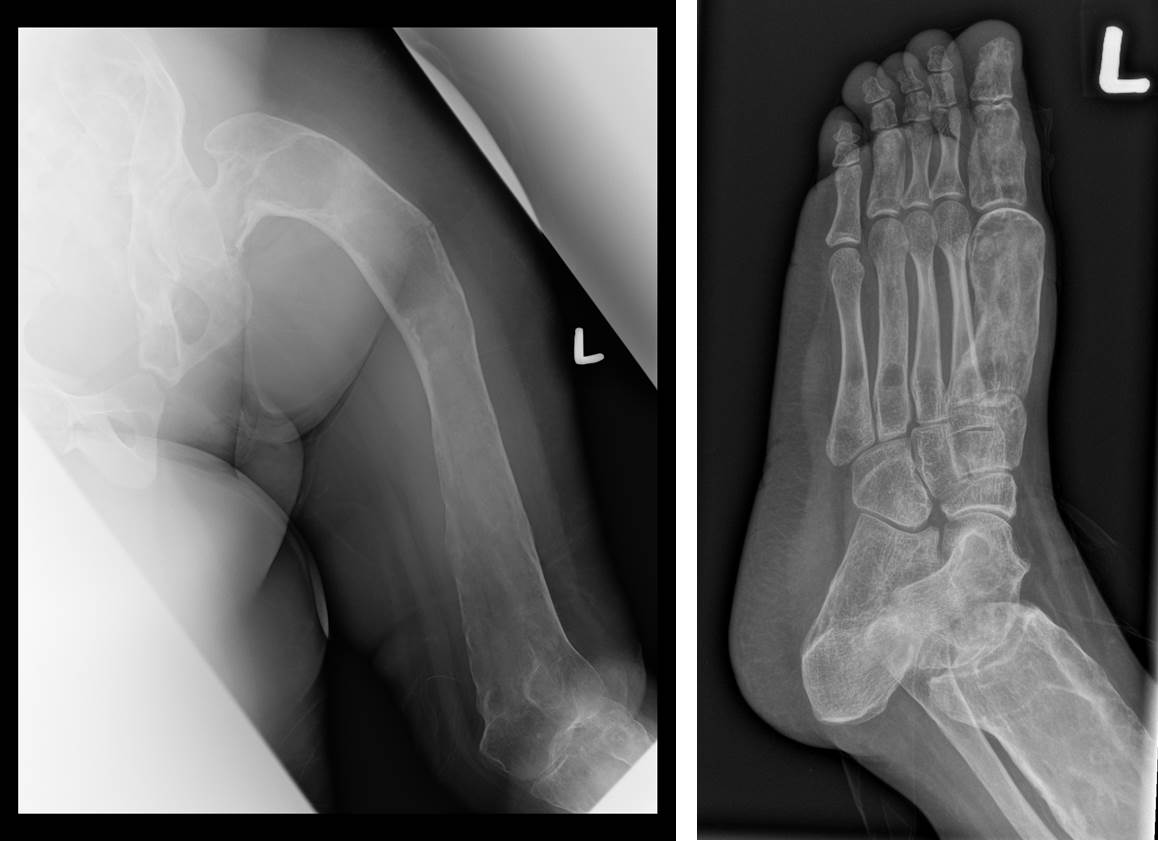 Polyostotic Fibrous Dysplasia Radiology Cases