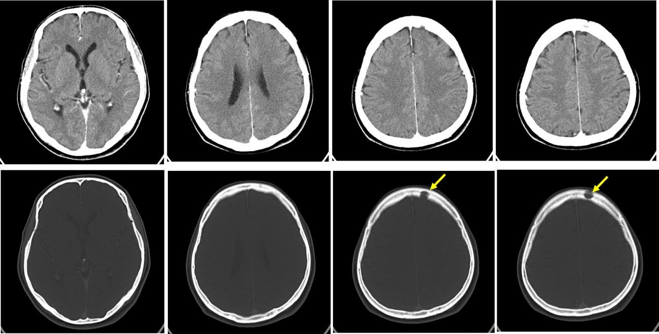 Lytic Skull Metastasis Radiology Cases