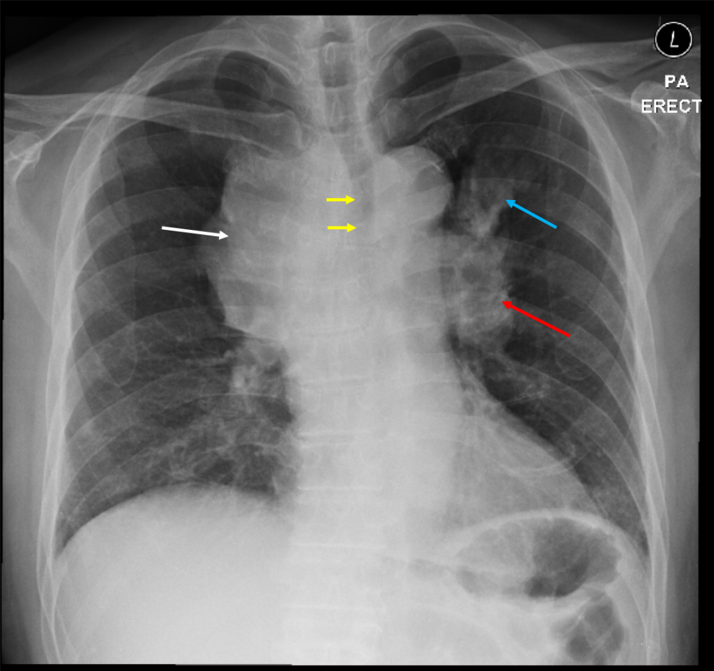 mediastinal-lymphadenopathies-lung-adenocarcinoma-radiology-cases