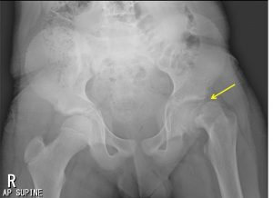 slipped capital femoral epiphysis