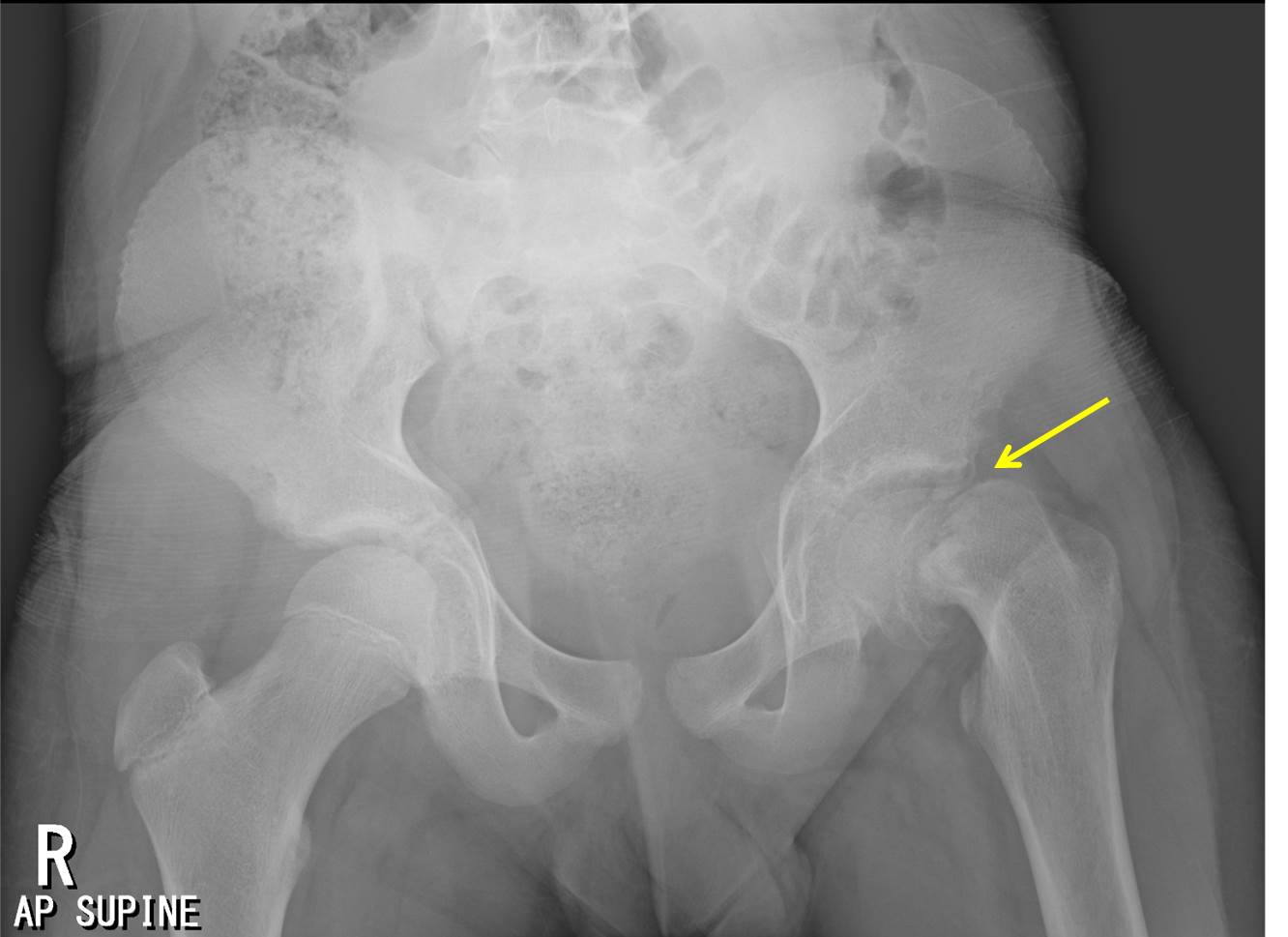 epiphysis of neck of femur