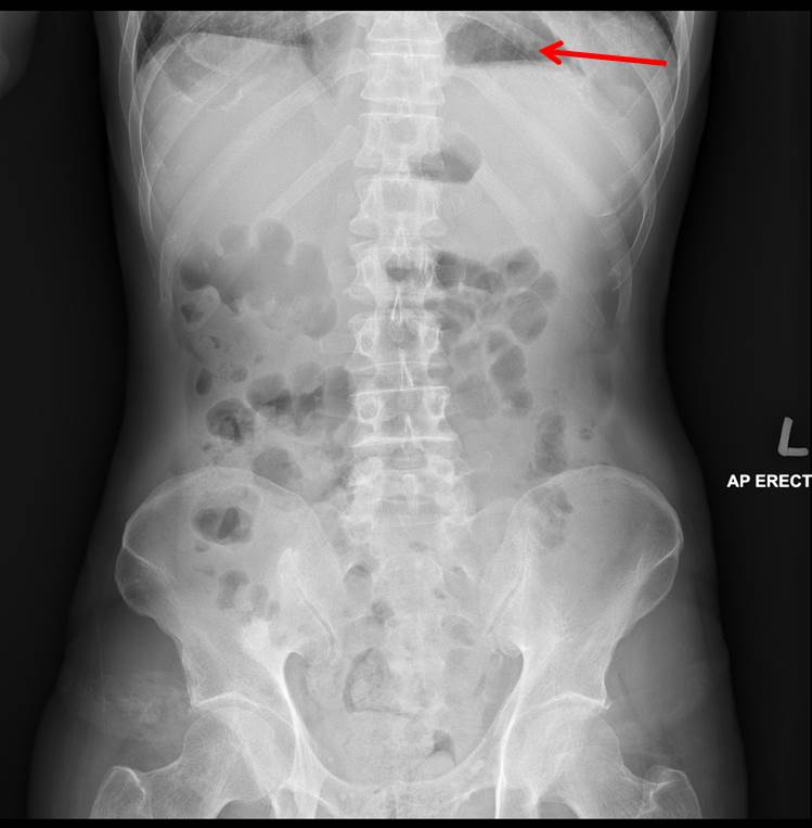 Isolated Dextrocardia – Radiology Cases