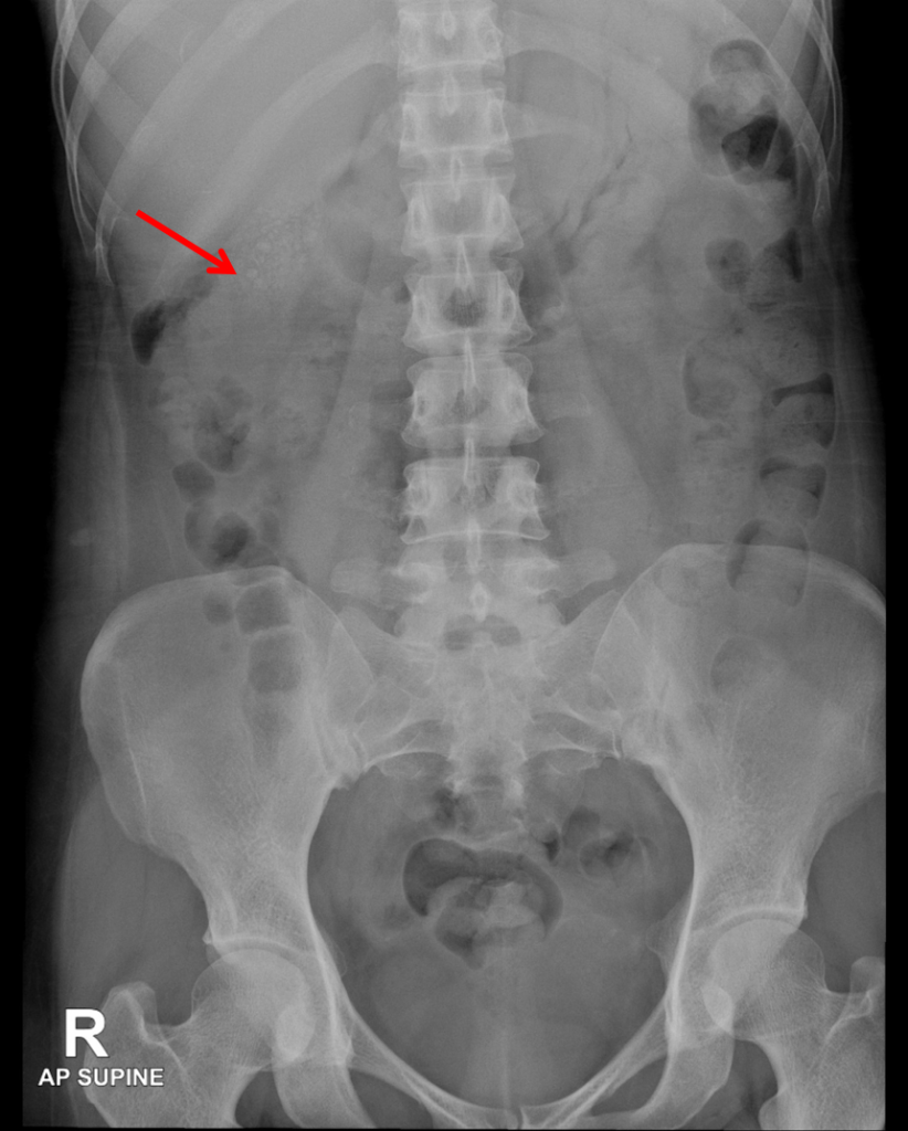 cholecystitis x ray