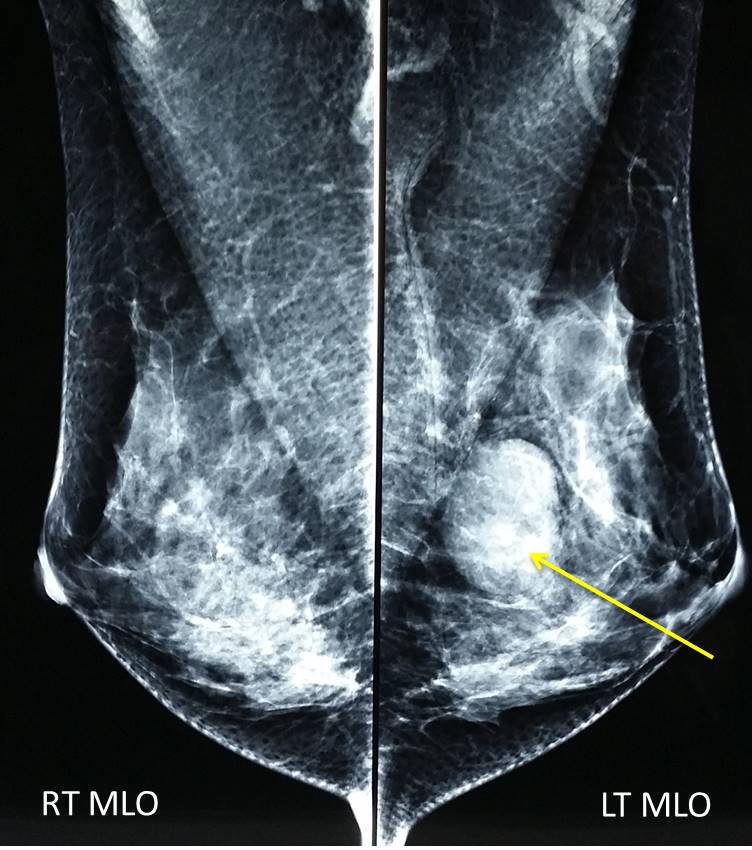 Simple breast cyst Radiology Cases