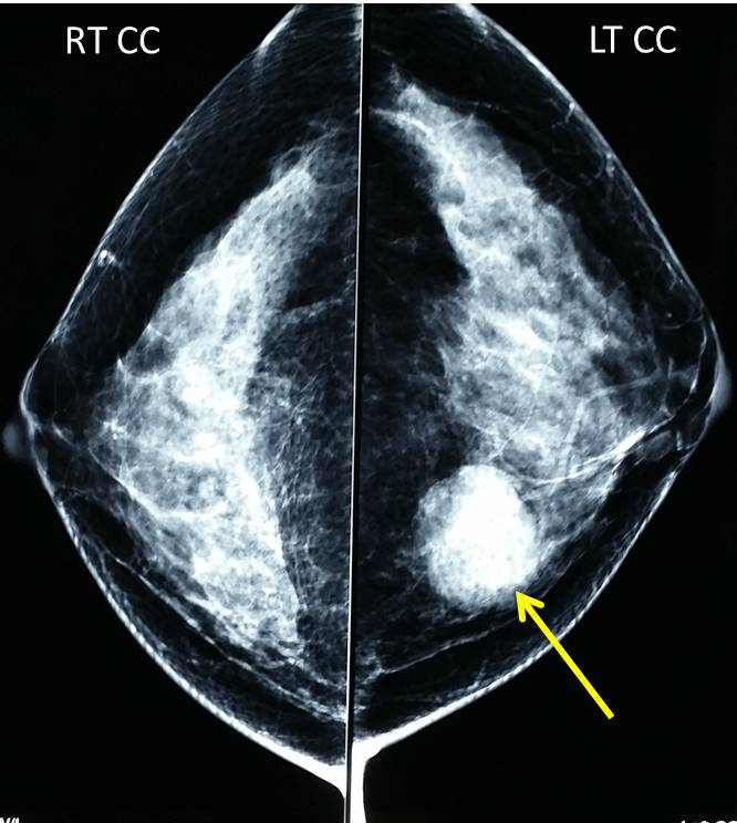 Simple breast cyst Radiology Cases