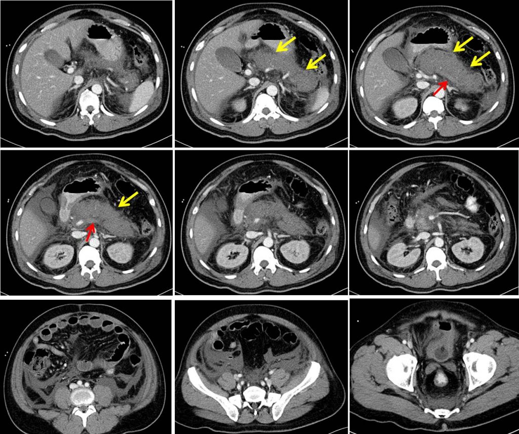 Necrotizing Pancreatitis Radiology Cases