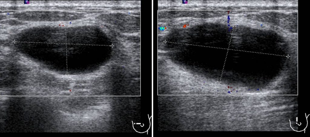 Simple Breast Cyst Radiology Cases