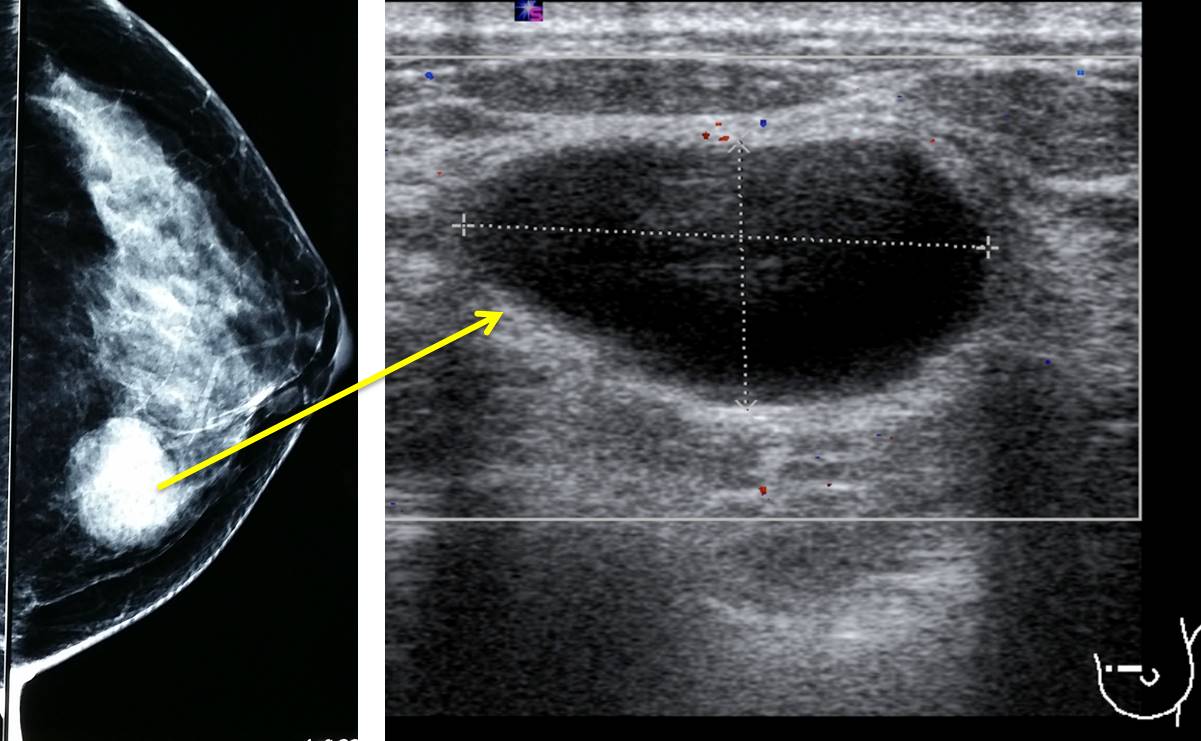 Simple Breast Cyst Radiology Cases