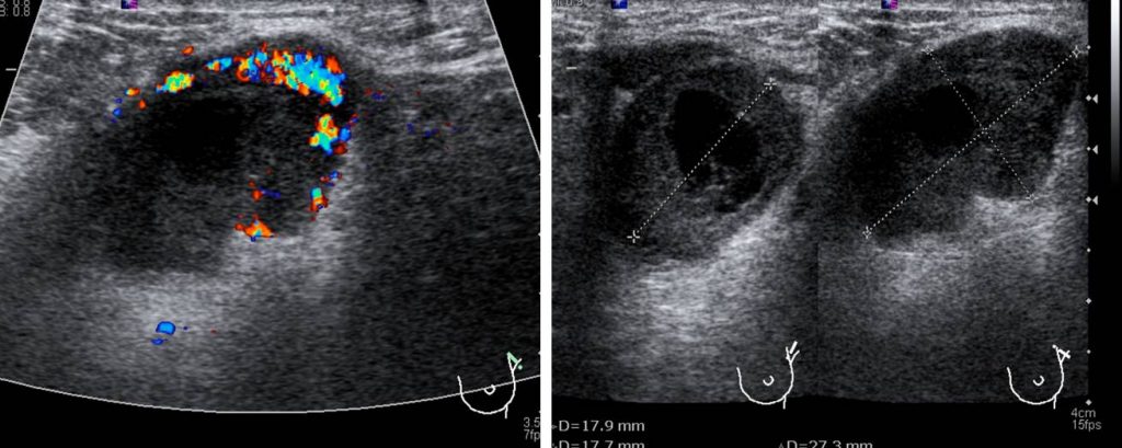 Invasive breast cancer (no special type)