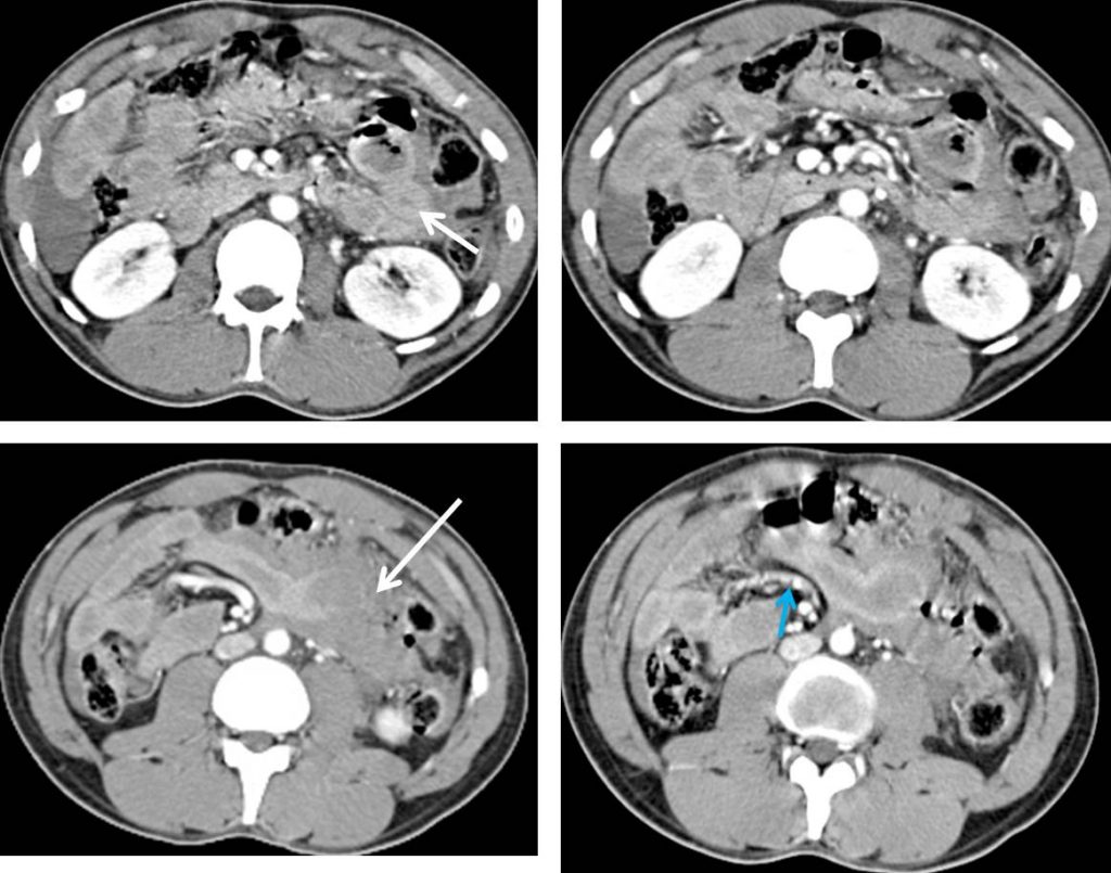 Blunt Abdominal Trauma Small Bowel And Mesenteric Injuries Radiology Cases