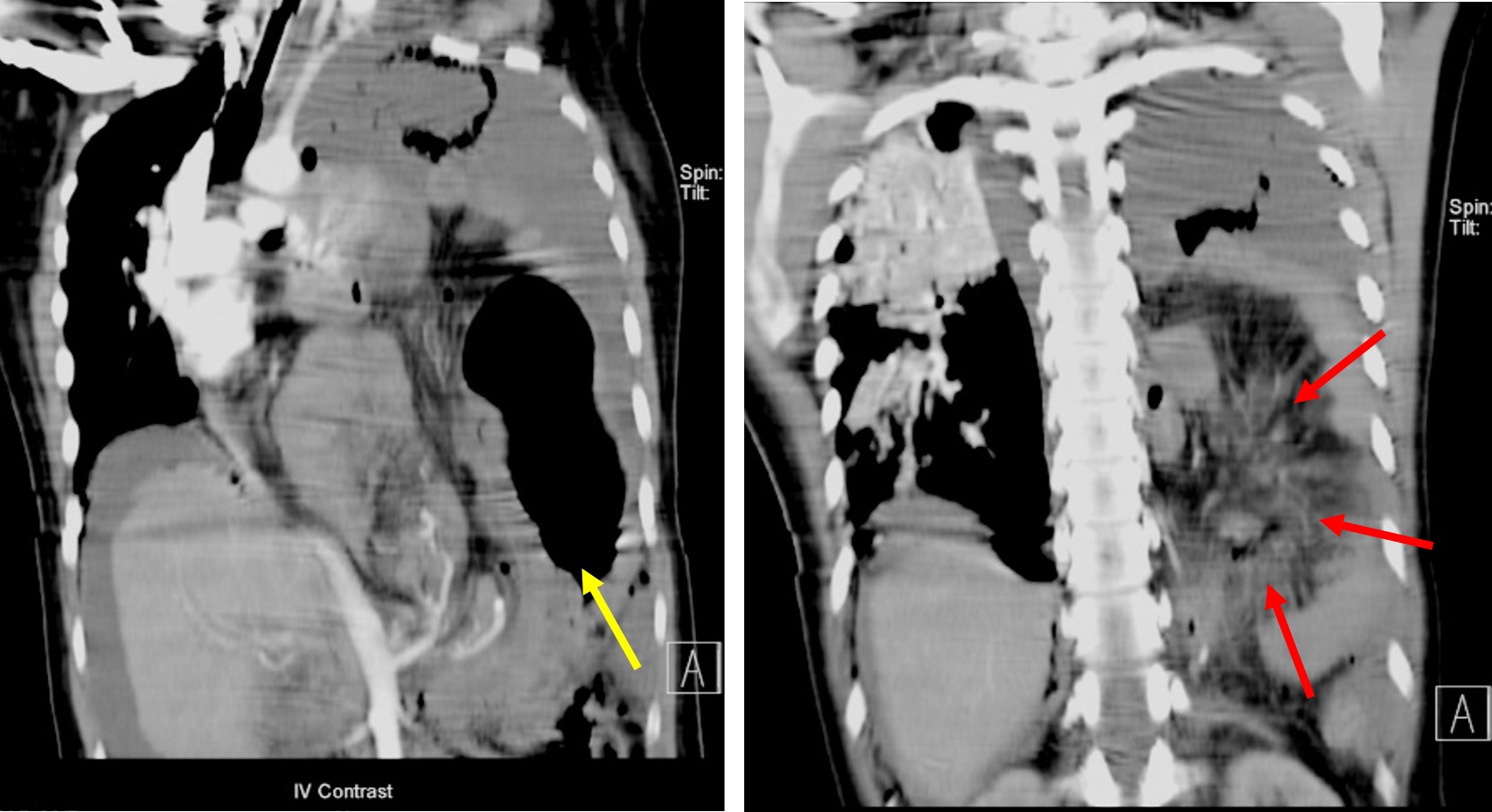 Diaphragmatic hernia Radiology Cases