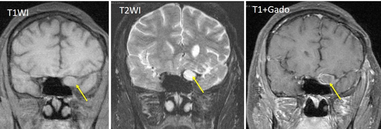 optic-nerve-glioma-radiology-cases