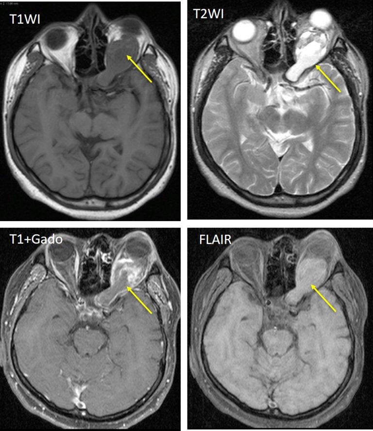 Optic nerve glioma Radiology Cases