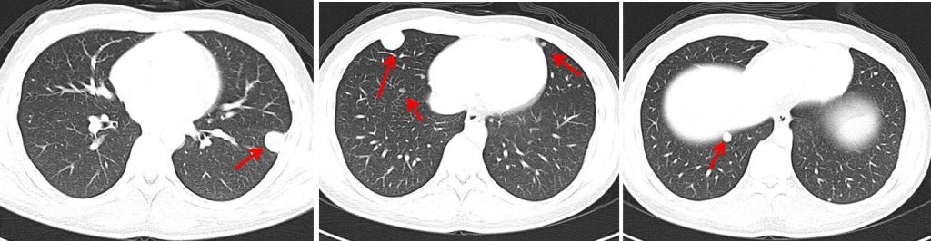 Testicular Cancer Embryonal Cell Carcinoma Radiology Cases