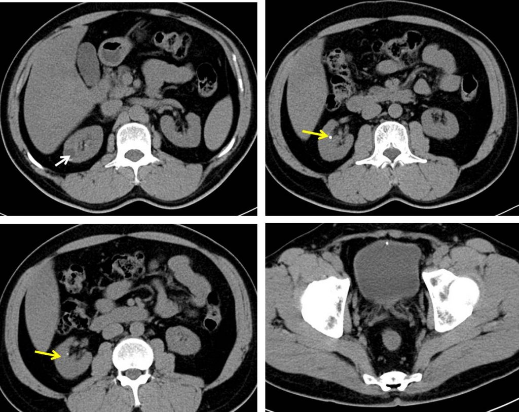 Urachal Remnant Calcification Radiology Cases