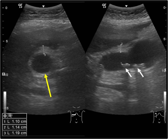 Gallbladder Empyema Radiology Cases