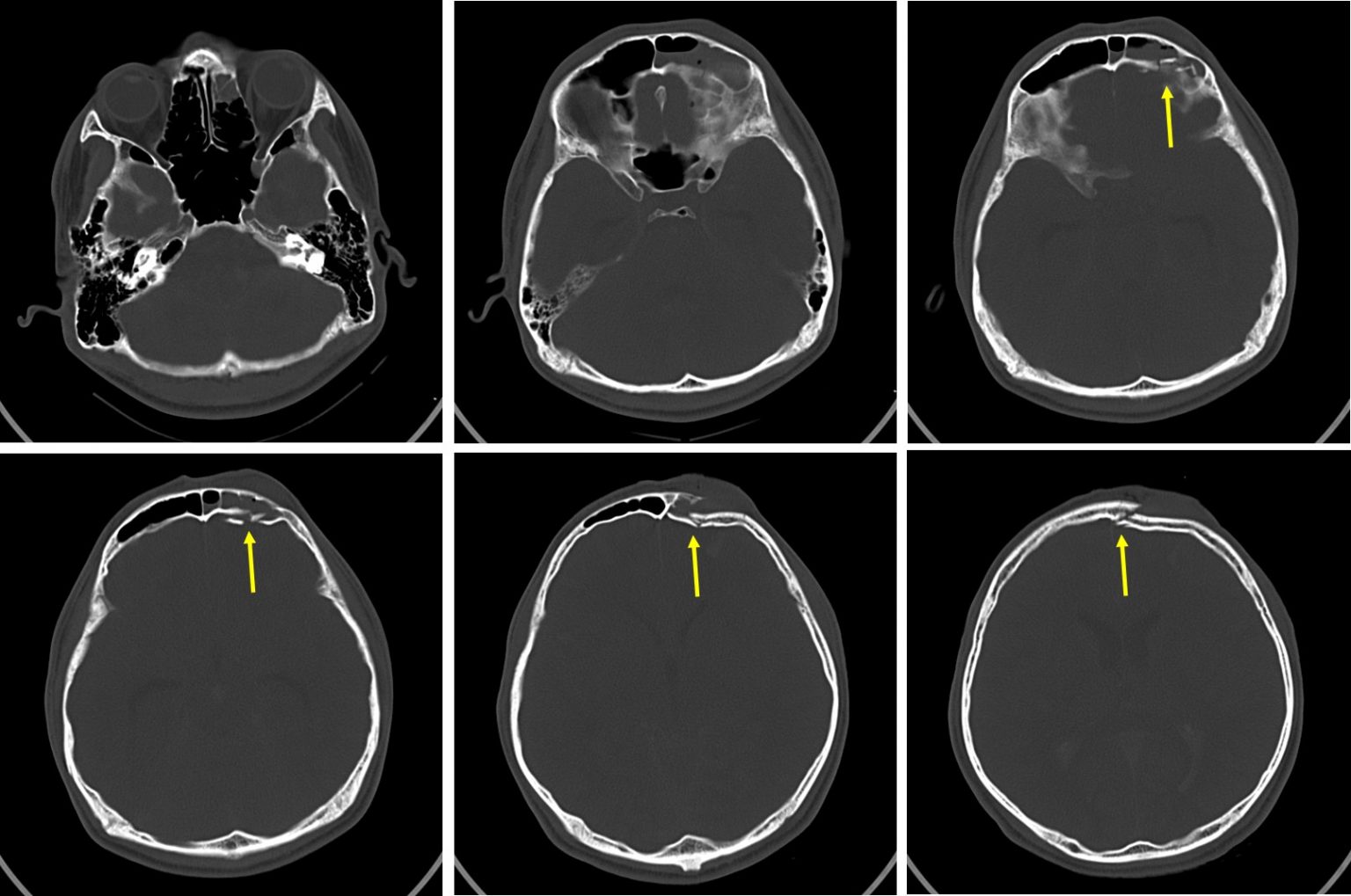 Frontal bone fracture and frontal sinus injury Radiology Cases