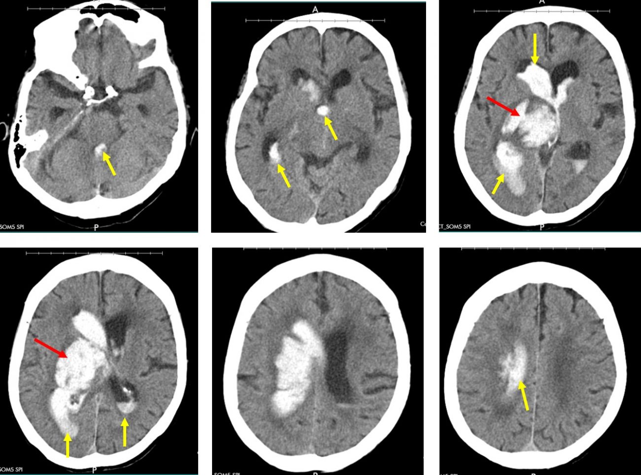 Basal ganglia hemorrhage Radiology Cases