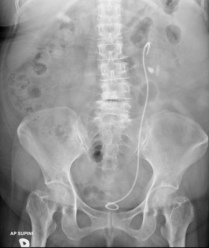 Renal Abscess With Perinephric Extension Radiology Cases