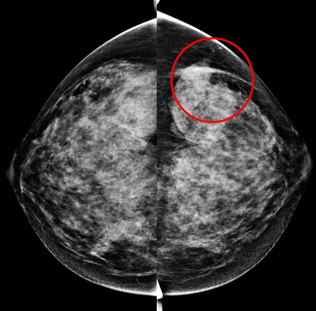 Mammogram focal asymmetry Radiology Cases