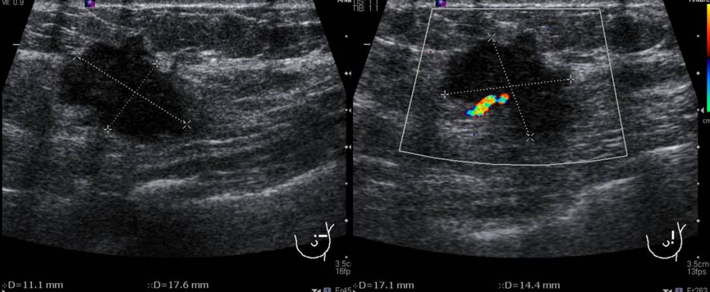 Mammogram: focal asymmetry – Radiology Cases