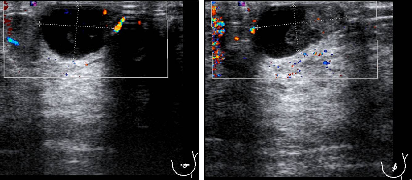 benign-breast-lesion-fibrocystic-change-with-possible-ductal-papilloma