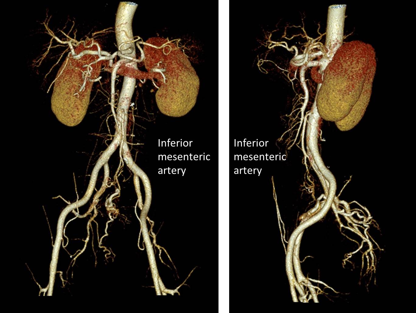 Ischaemic colitis Radiology Cases