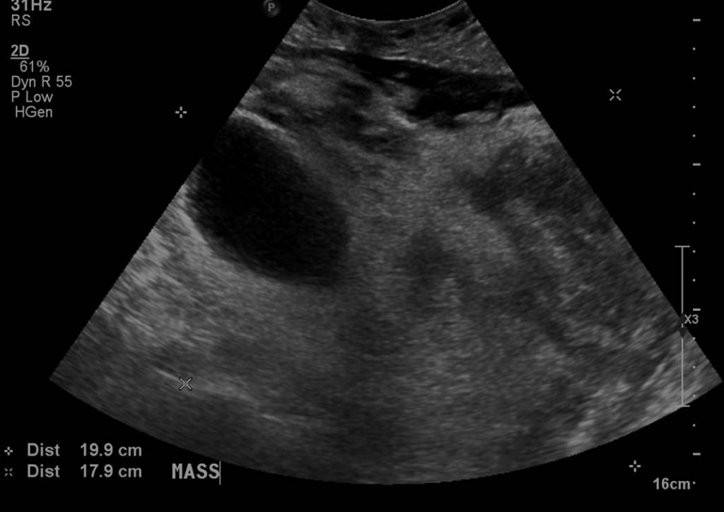 Pseudocystic Dedifferentiated Liposarcoma Mistaken For Peritoneal 