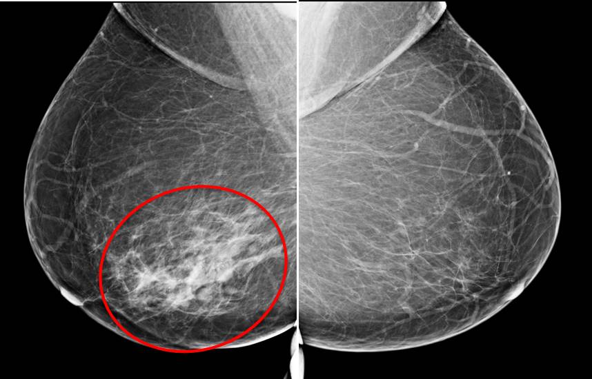 Invasive breast cancer (no special type)