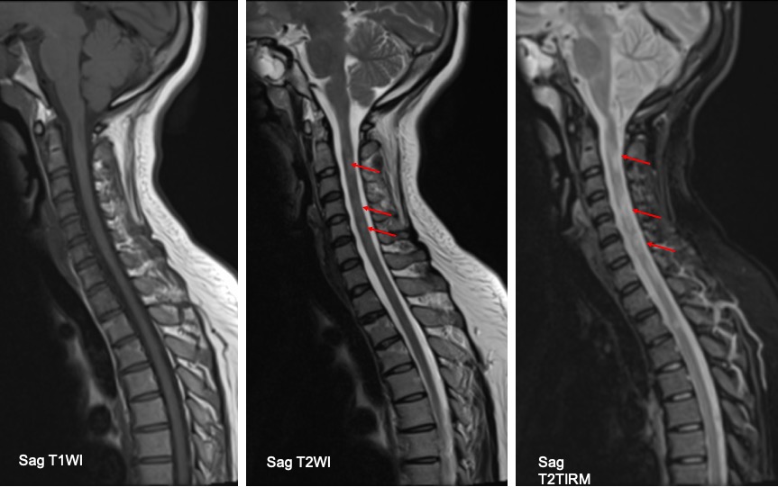 Multiple Sclerosis Radiology Cases