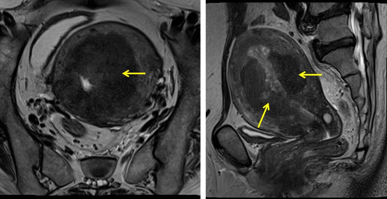 Endometrial Endometrioid Carcinoma Radiology Cases