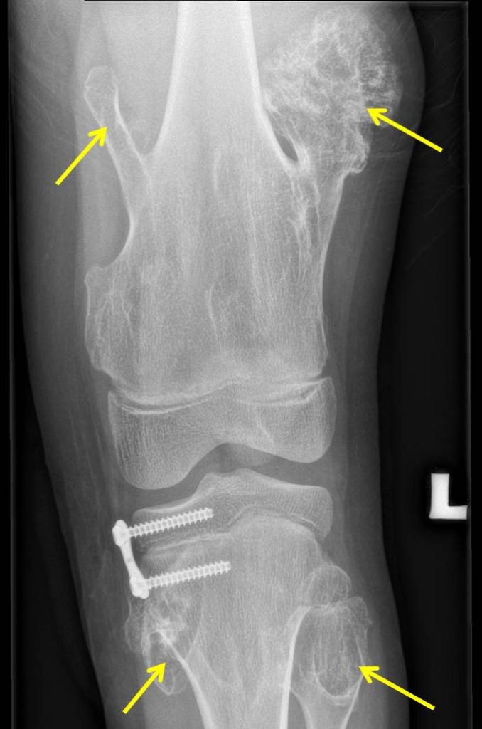 Hereditary multiple exostosis Radiology Cases