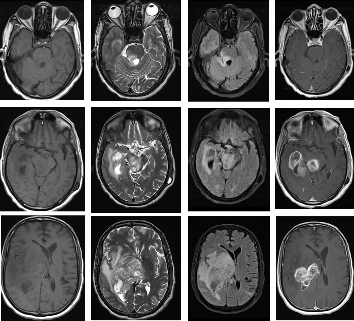 Glioblastoma Multiforme Radiology Cases 4855