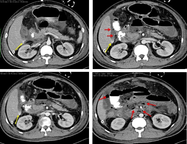 Blunt abdominal trauma with transected duodenum – Radiology Cases