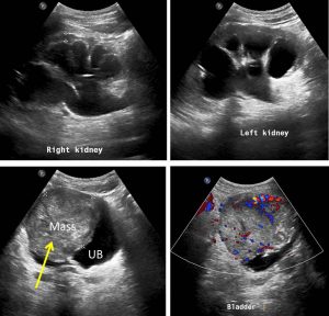 squamous cell carcinoma bladder gross