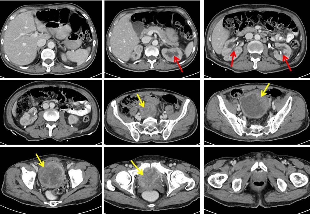 Squamous cell carcinoma of urinary bladder – Radiology Cases