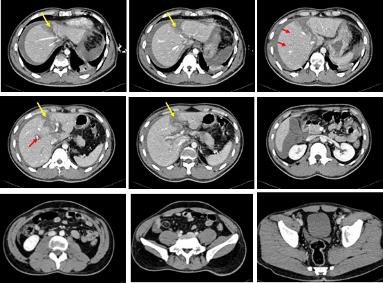 Ct Findings Of Periportal Tracking In Blunt Liver Injury Radiology Cases