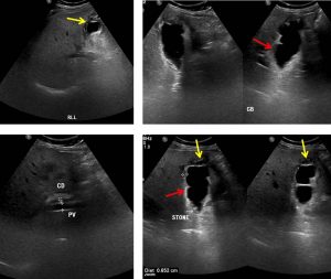 perforated gallbladder ultrasound