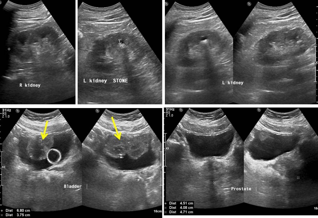 Synchronous urinary bladder and prostate cancer Radiology Cases