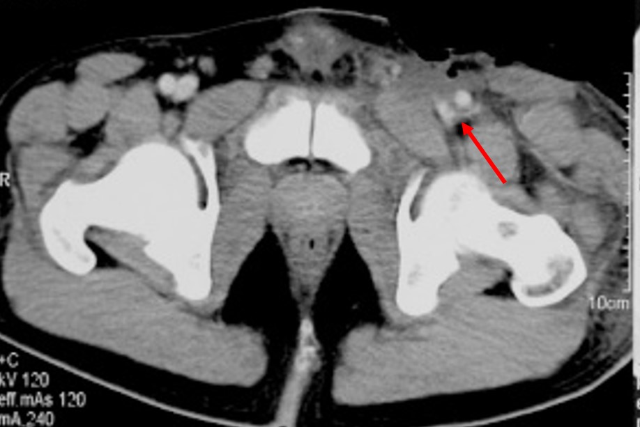 left femoral vein injury icd 10