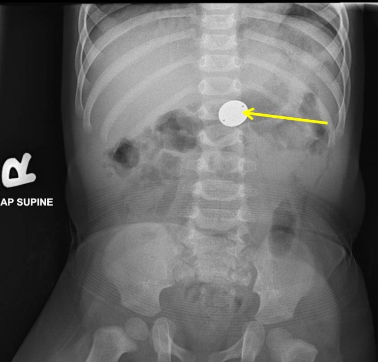 Coin ingestion Radiology Cases