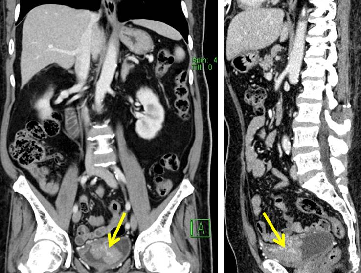 Synchronous Urinary Bladder And Prostate Cancer Radiology Cases