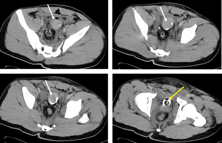 Blunt Abdominal Trauma: Posterior Urethral Injury – Radiology Cases