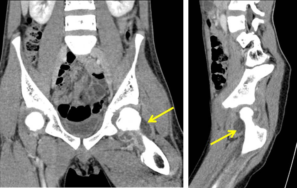 Septic arthritis of the hip Radiology Cases