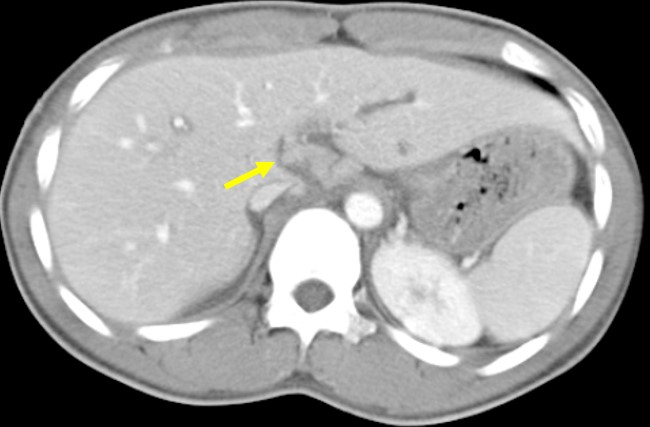 Grade I Liver Injury Radiology Cases