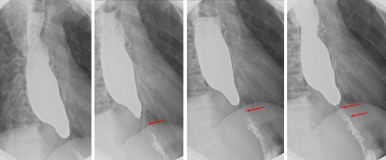 Esophageal Stricture Neoplasm Radiology Cases