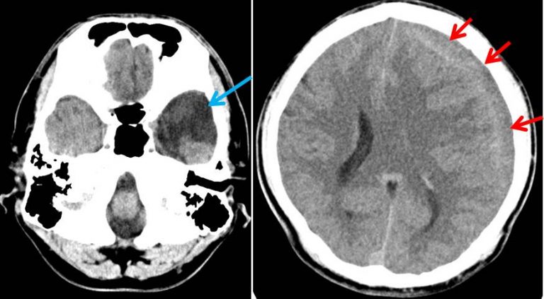 Arachnoid Cyst With Spontaneous Intracystic And Subdural Hemorrhage