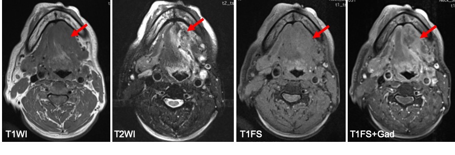 submandibular gland cyst