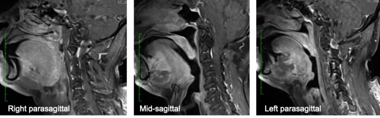 Adenoid Cystic Carcinoma Of Salivary Gland Sublingual Radiology Cases