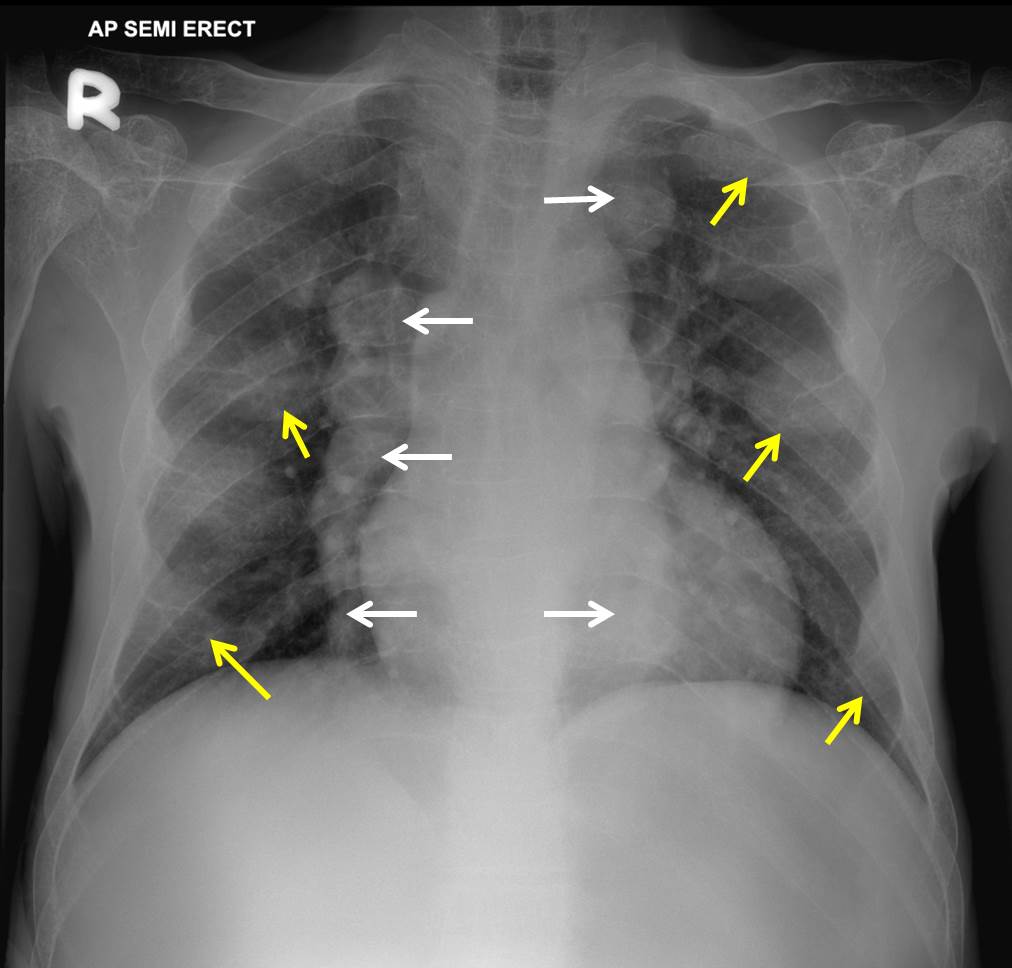 Extramedullary hematopoiesis Radiology Cases